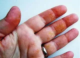 orange skin reaction to squash