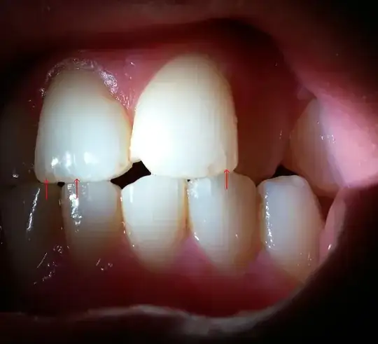 Teeth 2