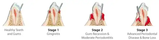 Stages of gum disease