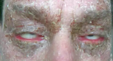 Cycatricial ectropion - closed eyes