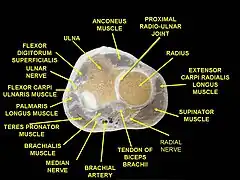 Muscles of upper limb.Cross section.