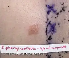 Patch test to isocyanate