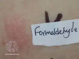 Positive patch test reaction to formaldehyde