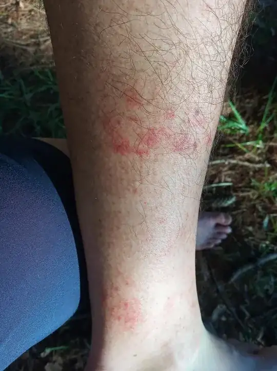 Rash on my lower leg