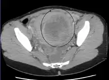 A very large (9&nbsp;cm) fibroid of the uterus which is causing pelvic congestion syndrome as seen on CT